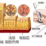 成都王欣医生吸脂多少钱？华生铂悦威塑抽脂价格6千元起，修复2-4万不等