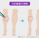注射瘦腿效果怎么样？吸脂多久才能恢复自然