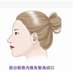 颧骨整形多少钱啊？医院选择影响价格，术前必看