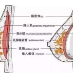 青岛隆胸多少钱？价格查询及手术结果与风险解析