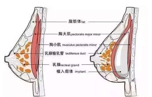 合肥自体脂肪隆胸贵吗？价格解析与手术前后护理策略
