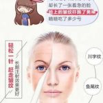 眉间注射除皱多少钱