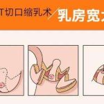 无锡缩胸手术一般多少钱？手术费用的高低和哪些因素有关