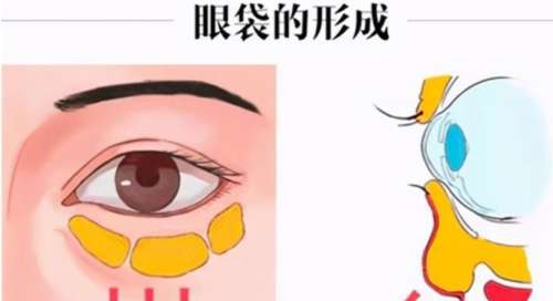 上海去眼袋手术费用大概多少钱