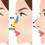 鼻畸形矫正价格贵吗多少钱？手术后遗症提前看