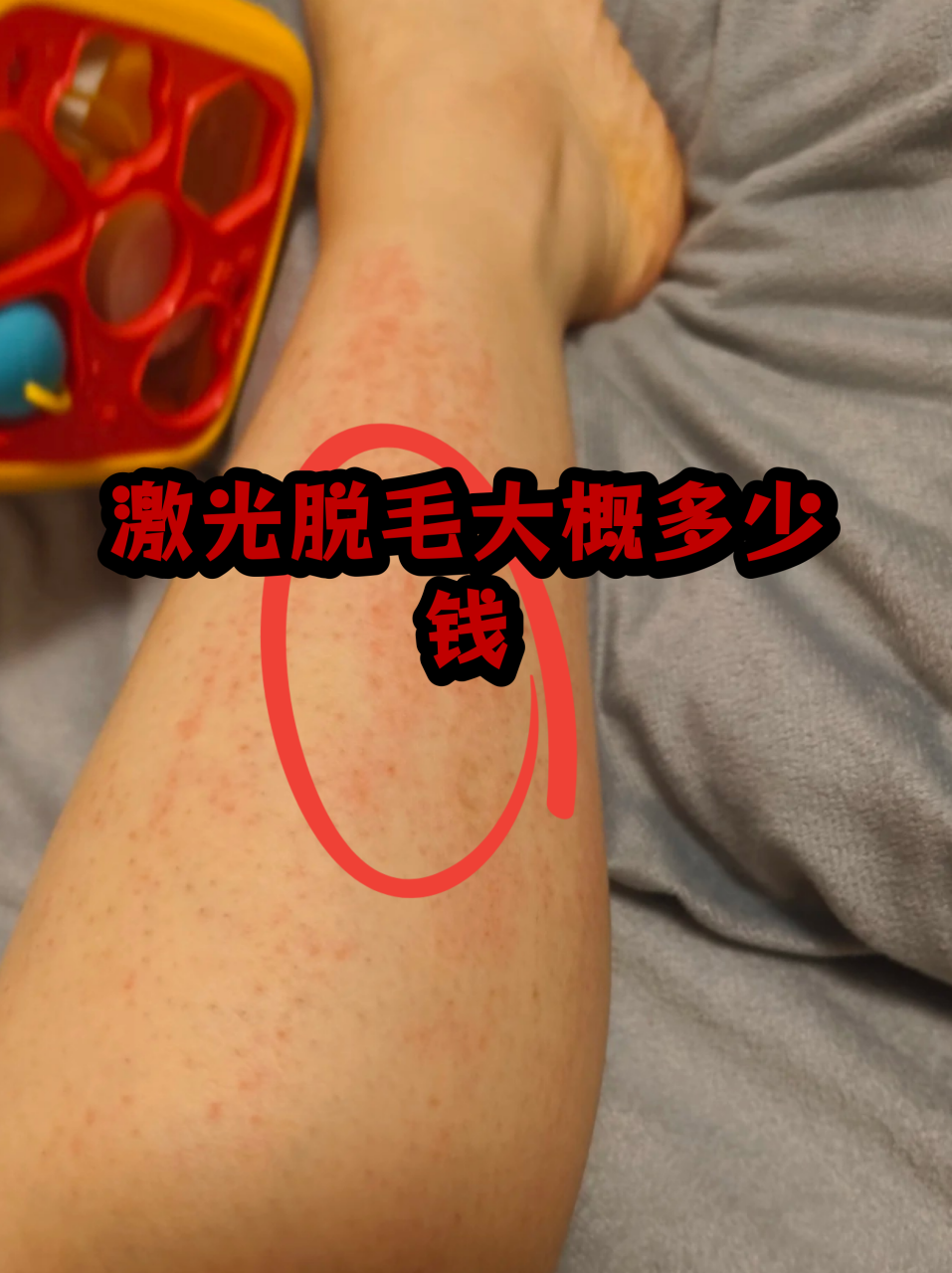 北京做激光脱毛要多少钱？激光脱毛服务费用及选择建议