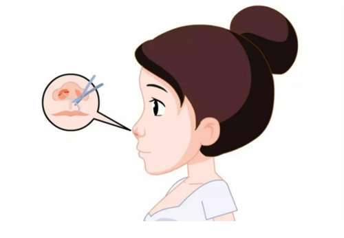 吉林肋骨隆鼻价格贵不贵？客观揭秘自认隆鼻术式的价格