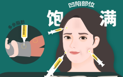 萧山人民医院脂肪填充多少钱，价格盘点：一次大概多少钱、要做几次才自然
