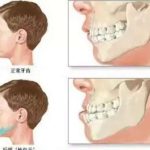 上骨突出矫正一般要多少钱？一般是在2万元到8万元之间