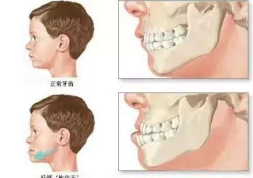 上骨突出矫正一般要多少钱？一般是在2万元到8万元之间