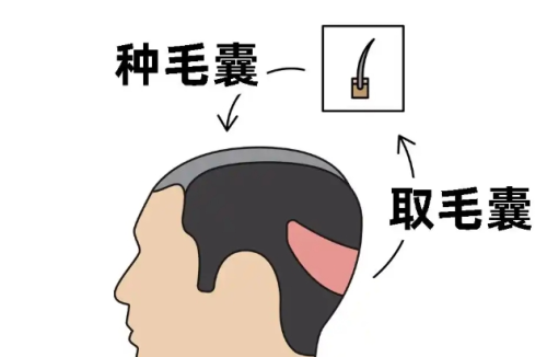 杭州市第一人民医院植发价格，发友亲测价格明细、植发单位数和效果对比