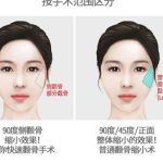 颧骨内推整形手术多少钱？预览收费明细