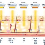 广州做AOPT超光子嫩肤价格揭秘与避坑指南