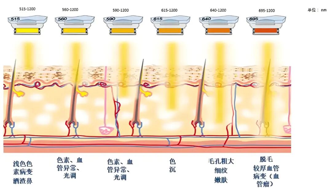 广州做AOPT超光子嫩肤价格揭秘与避坑指南