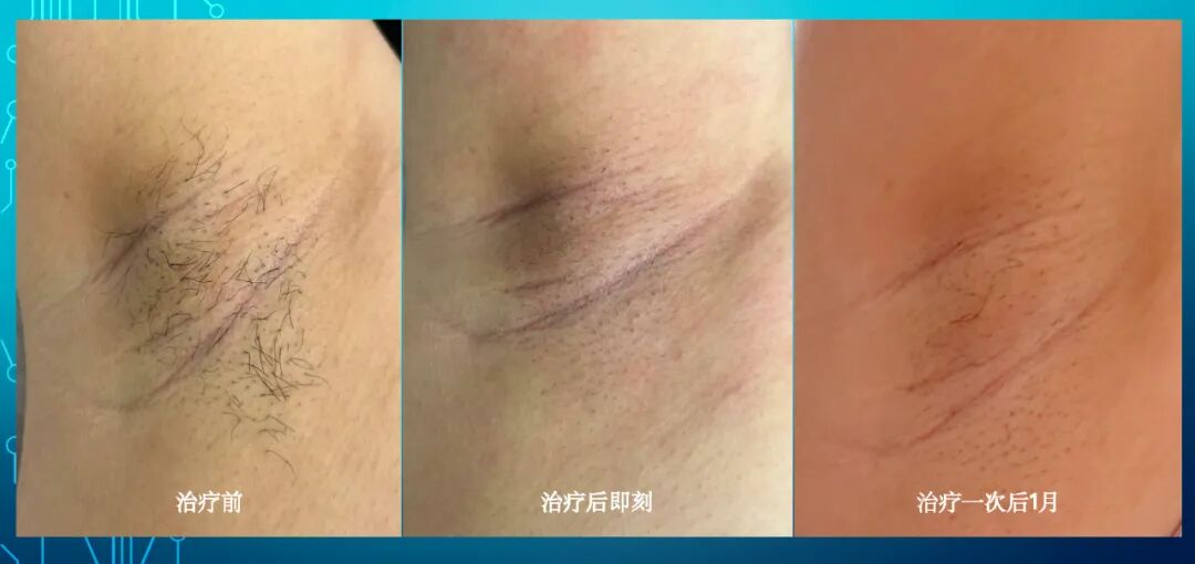 广州激光脱毛预约攻略：夏天前搞定光滑肌需要多少钱多久？