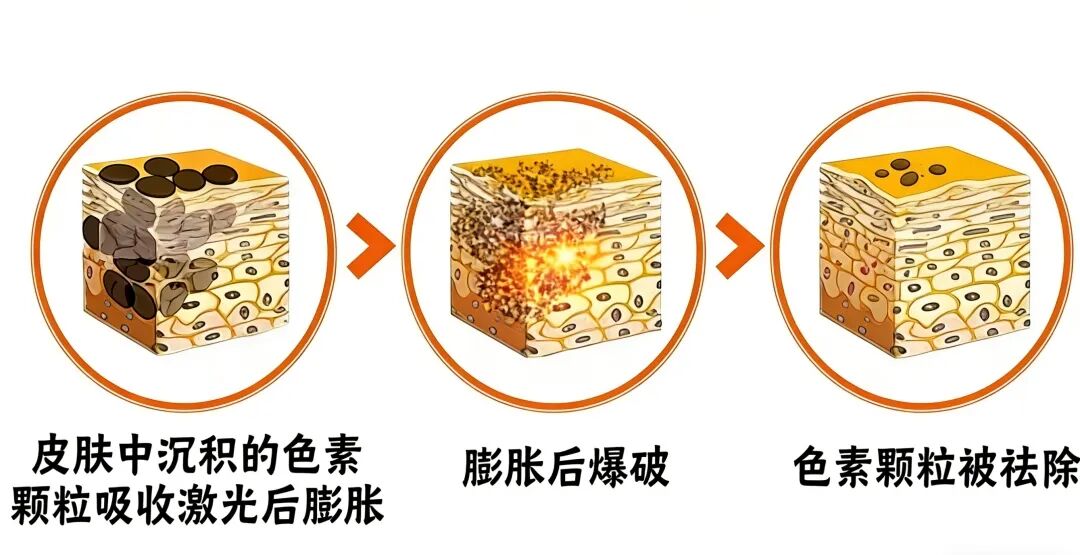 广州做超皮秒祛斑到底要多少钱？2026年最新价格揭秘