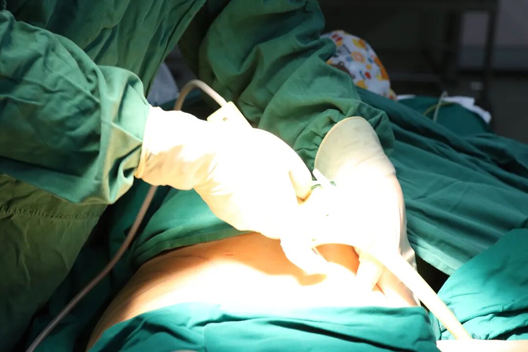 广州吸脂到底选谁？顶尖医生排名与避坑指南