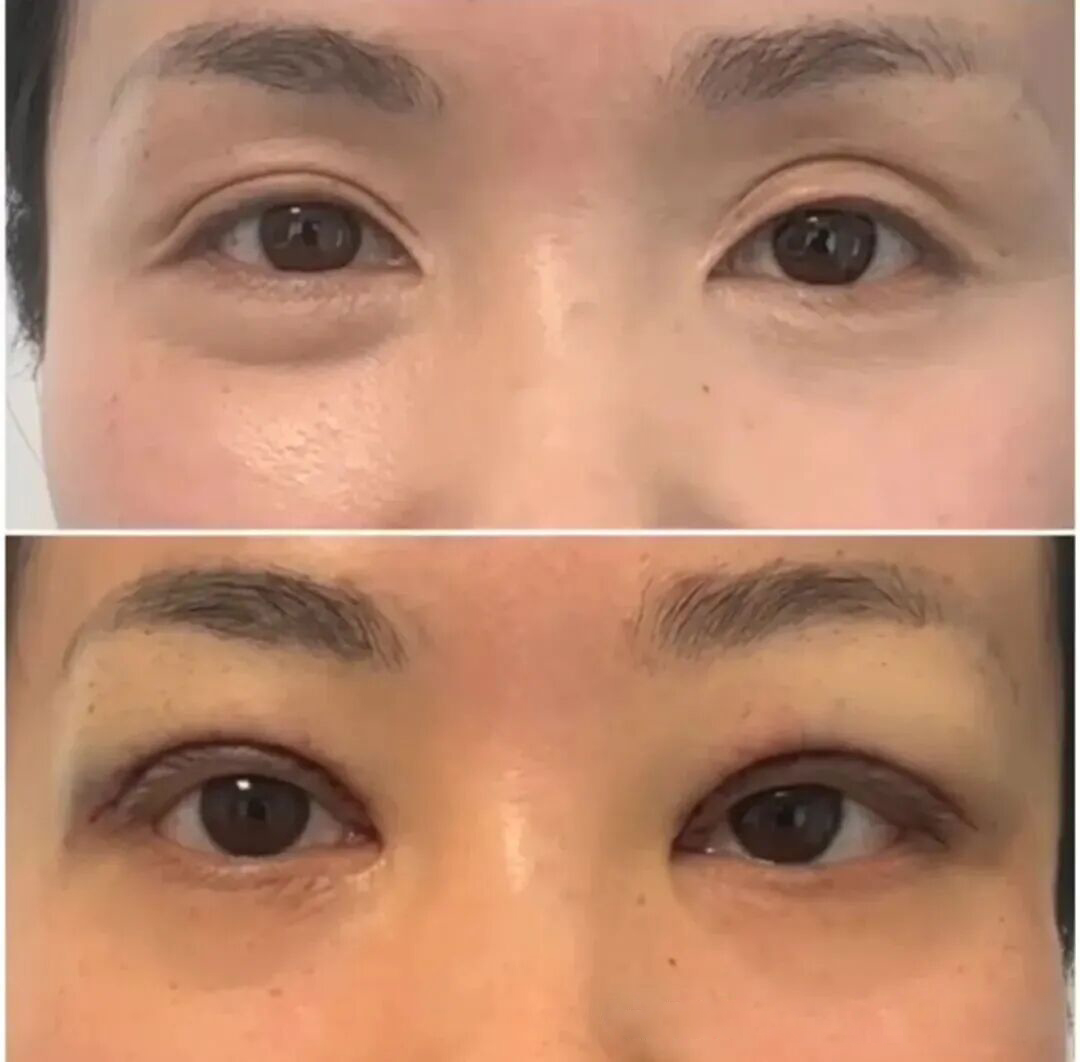 广州眼修复多少钱||广州眼部整形手术费用及注意事项