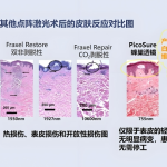 超皮秒祛斑会反弹吗？揭秘真实恢复真相与防复发关键