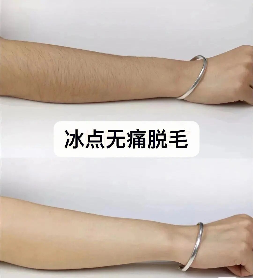 北京冰点脱毛价格多少钱？冰点脱毛服务费用