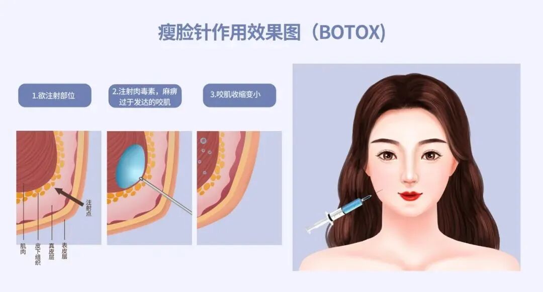 北京衡力瘦脸针多少钱一次？衡力瘦脸针注射费用及效果