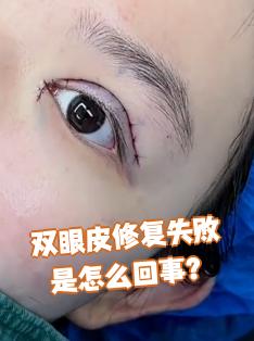 双眼皮手术失败了怎么办？双眼皮修复手术成功率及注意事项详解