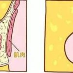 苏州缩胸手术多少钱？哪位医生的技术比较好？会有后遗症吗