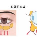 石家庄祛眼袋多少钱？看不同手术方式价格区别
