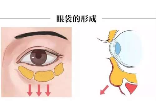 石家庄去眼袋手术价格贵吗？认清眼部紧致手术真实花费轮廓