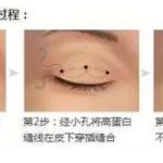 杭州陈海华双眼皮修复案例|从假宽肉条到自然妈生眼，普通人修复全记录