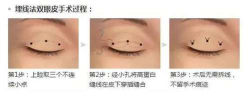 杭州陈海华双眼皮修复案例|从假宽肉条到自然妈生眼，普通人修复全记录