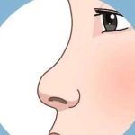 沈阳玻尿酸隆鼻价位多少钱