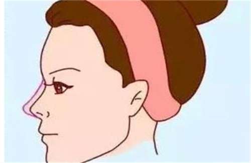 硅胶隆鼻多少钱？硅胶隆鼻多久能恢复？点击了解