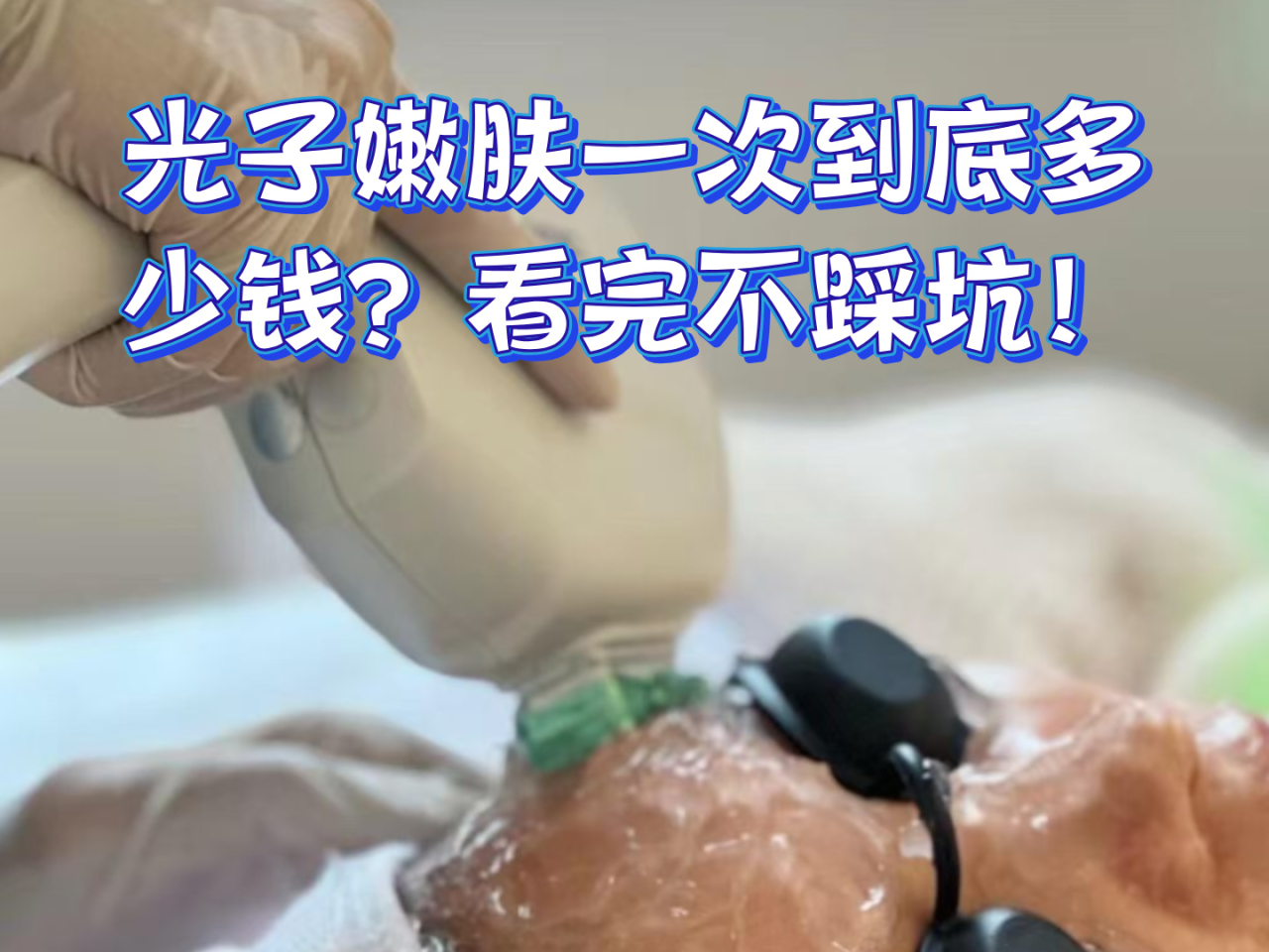 深圳超光子嫩肤多少钱一次？效果如何？