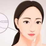 下颌角和颧骨一起整多少钱？手术安全性如何？注意事项介绍