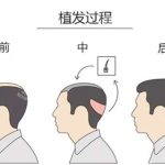武汉植发多少钱一次？浓密毛发值得拥有