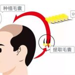 石家庄植发手术的收费标准是什么？透视头顶之美投入成本分析