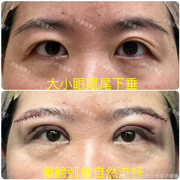 广州双眼皮修复多少钱？