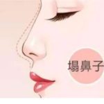 青岛假体隆鼻贵还是肋骨隆鼻贵？全新2026年价格表更新