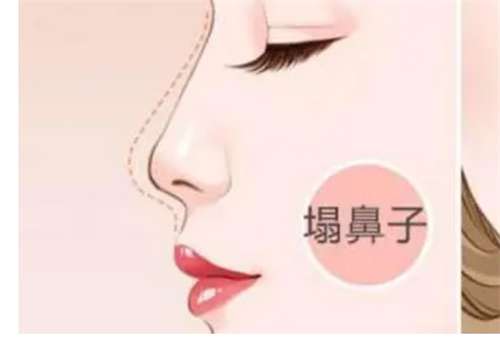 青岛假体隆鼻贵还是肋骨隆鼻贵？全新2026年价格表更新