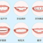 地包天矫正一般费用是多少