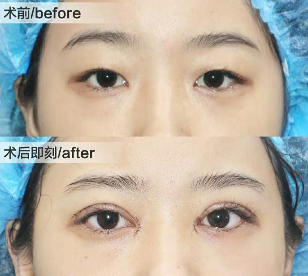 韩式双眼皮医院哪家好？如何选择最佳韩式双眼皮整形医院指南
