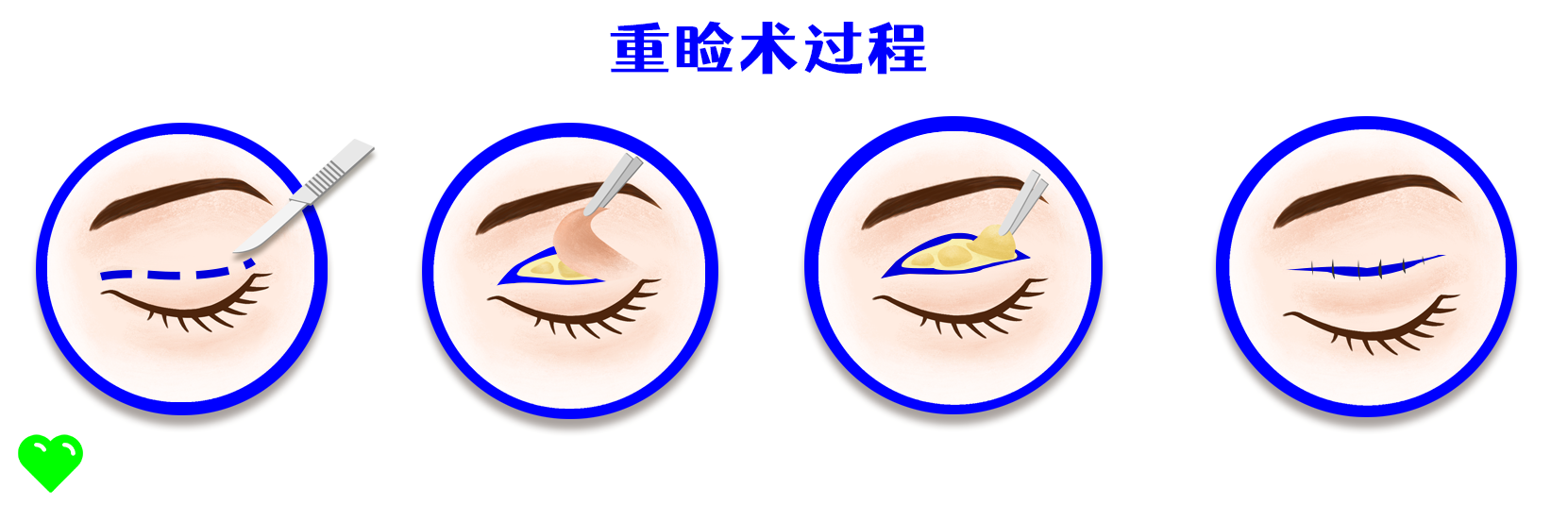双眼皮手术有疤痕怎么办？