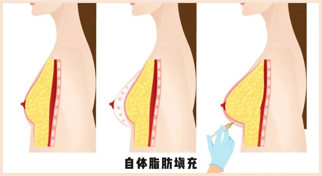 做脂肪隆胸有哪些危害？自体脂肪隆胸300cc能大多少？