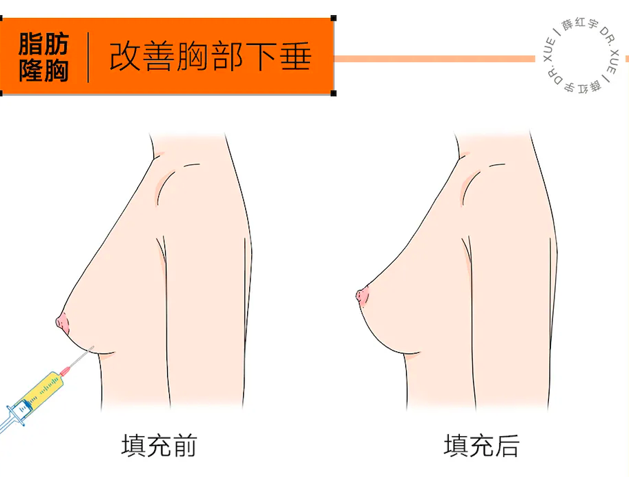 自体脂肪隆胸能摸出来吗？自体脂肪隆胸可以改善下垂吗？