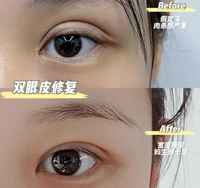 杭州双眼皮修复手术价格多少钱？