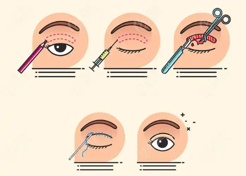 杭州眼修复手术预约指南 | 如何在杭州找到专业靠谱的眼修复医院