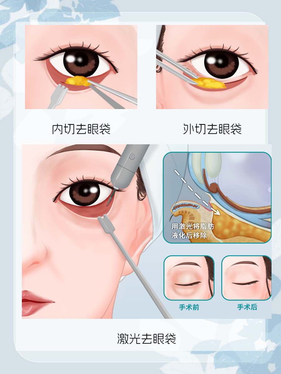 广州眼袋手术三甲医院有哪些珠江医院、广医一院、孙逸仙医院脱颖而出