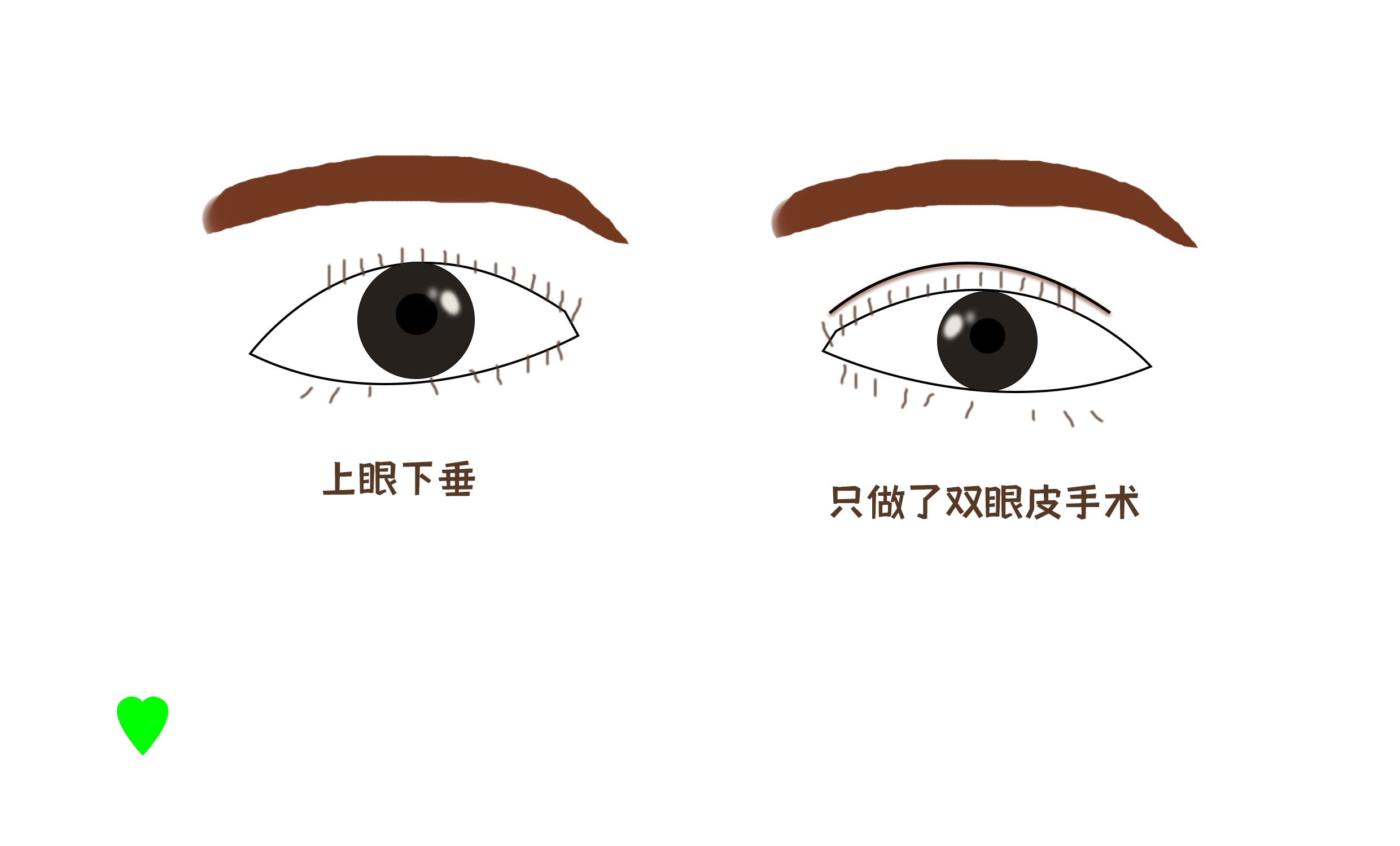 双眼皮手术多久能恢复自然