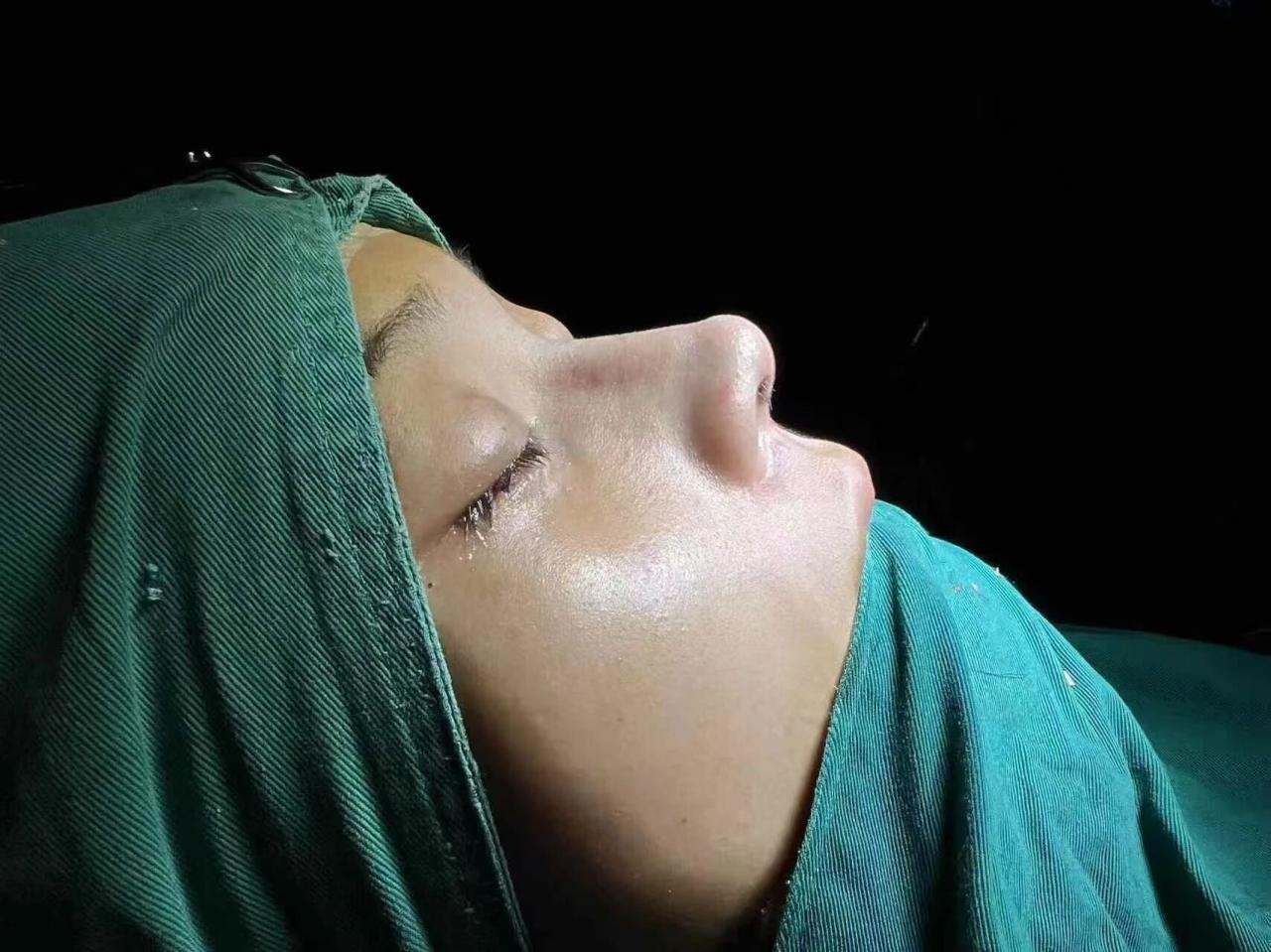 隆鼻手术后增生要怎么才消失掉呢？隆鼻有什么副作用？